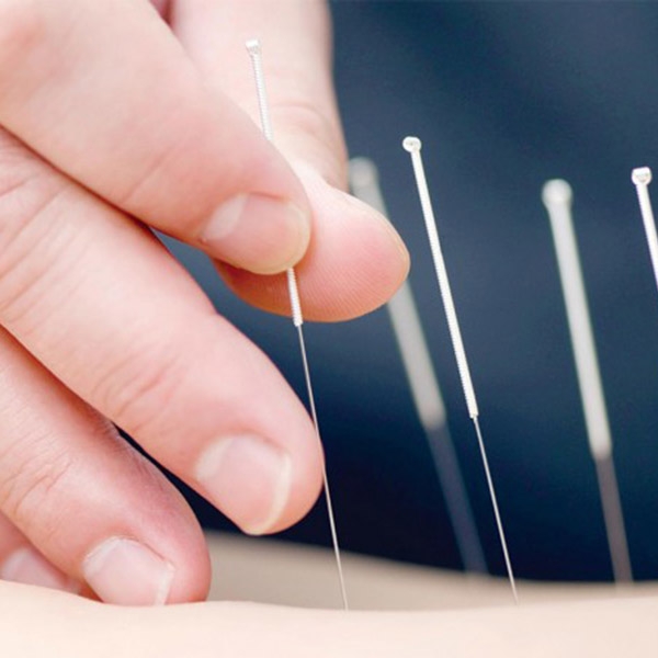 Acupuntura
